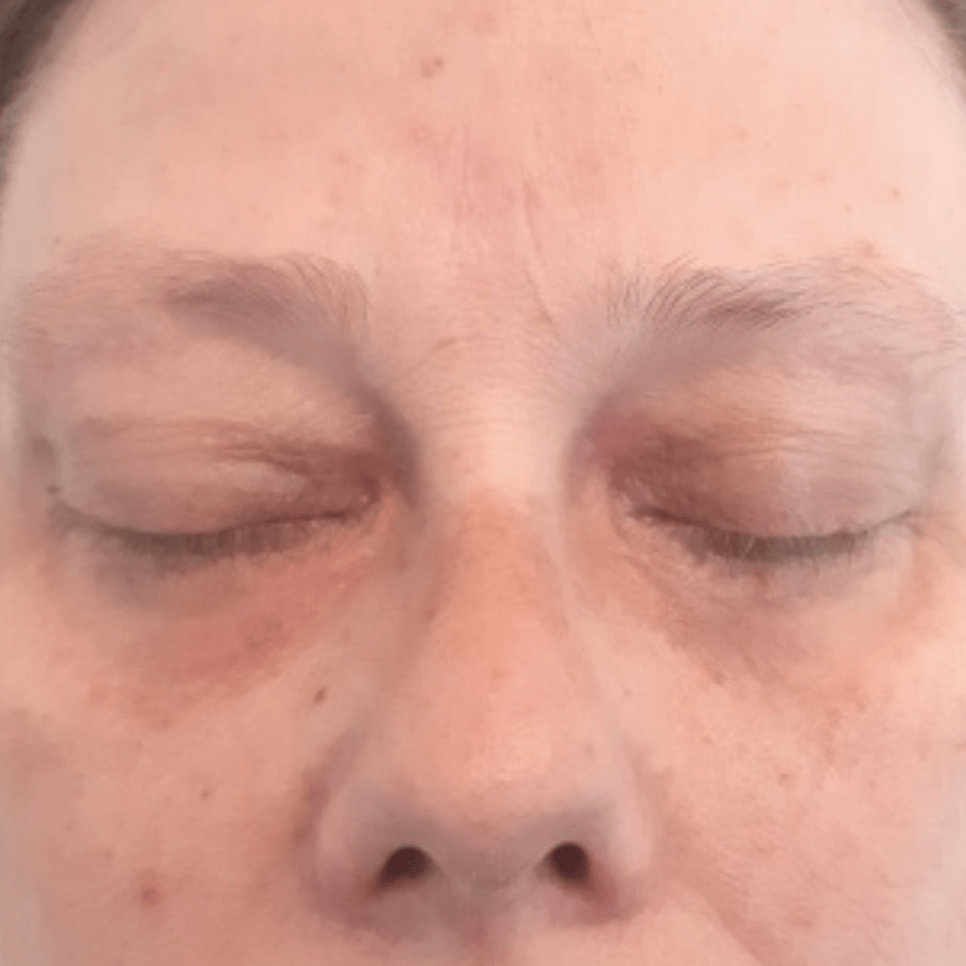 Efter behandling af xanthelasma - Hudlæge Alba Privathospital