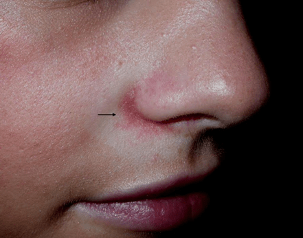 Perioral dermatitis - Hudlæge Alba Privathospital