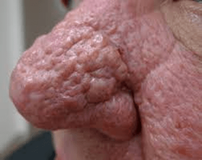 Laseroperation for rhinophyma