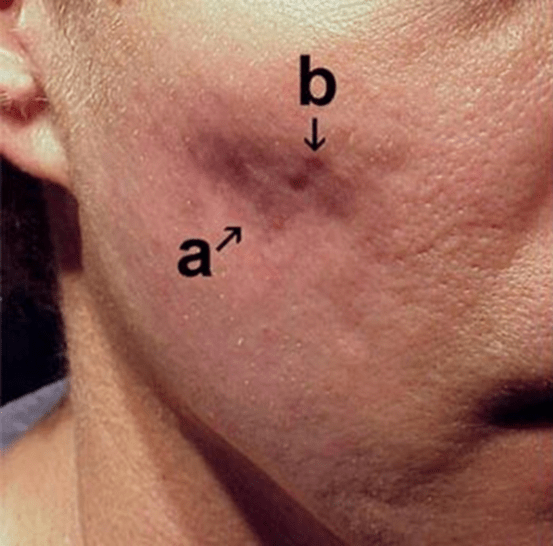 Før subcision af aknear - Hudlæge Alba Privathospital