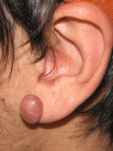 Hvad er keloid ar & hypertrofiske ar