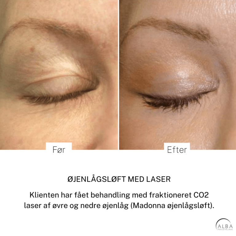Øjenlågsløft med laser før efterbillede - Alba Privathospital