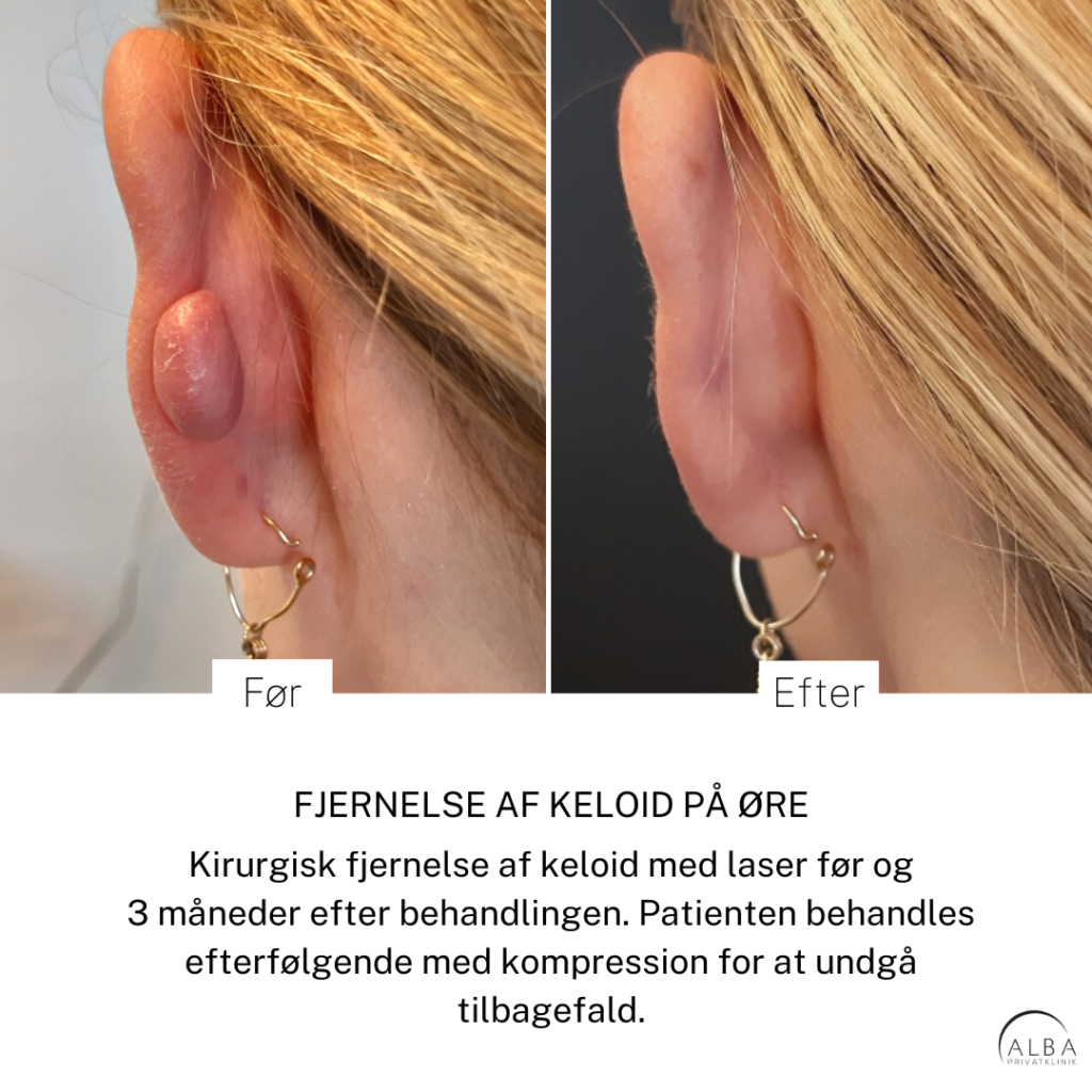 Behandling af keloid på øre - Før og efter - Alba Privathospital